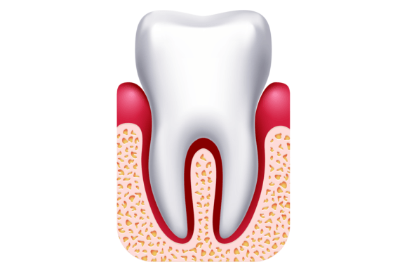 Download Gingivitis Illustration. Gum Disease. De - Illustration Collection